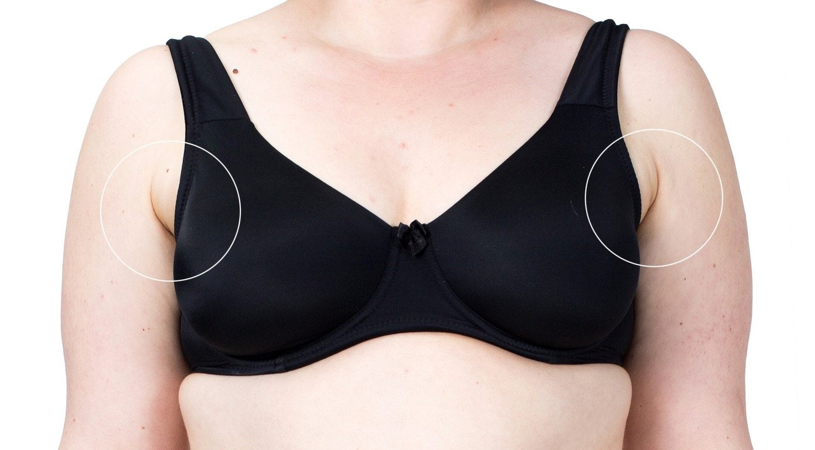 Kybella for unsightly bra fat